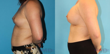 Breast Augmentation case #5644