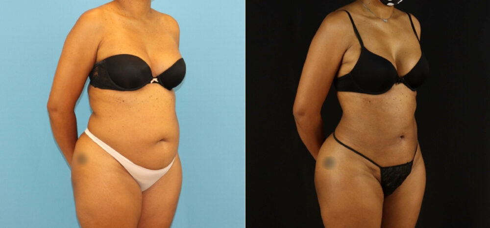 Brazilian Butt Lift case #5115