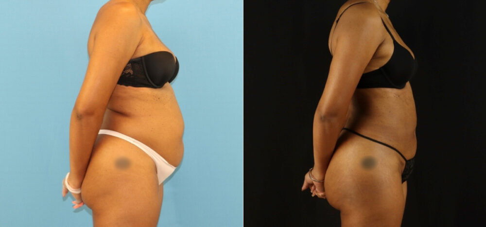 Brazilian Butt Lift case #5115