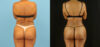 Brazilian Butt Lift case #5115 slider thumbnail