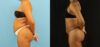 Brazilian Butt Lift case #5115 slider thumbnail