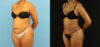 Brazilian Butt Lift case #5115 slider thumbnail