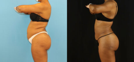 Brazilian Butt Lift case #5115