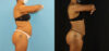 Brazilian Butt Lift case #5115 slider thumbnail