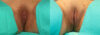 Labiaplasty case #5768 slider thumbnail
