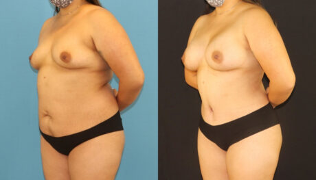 Mommy Makeover case #6513