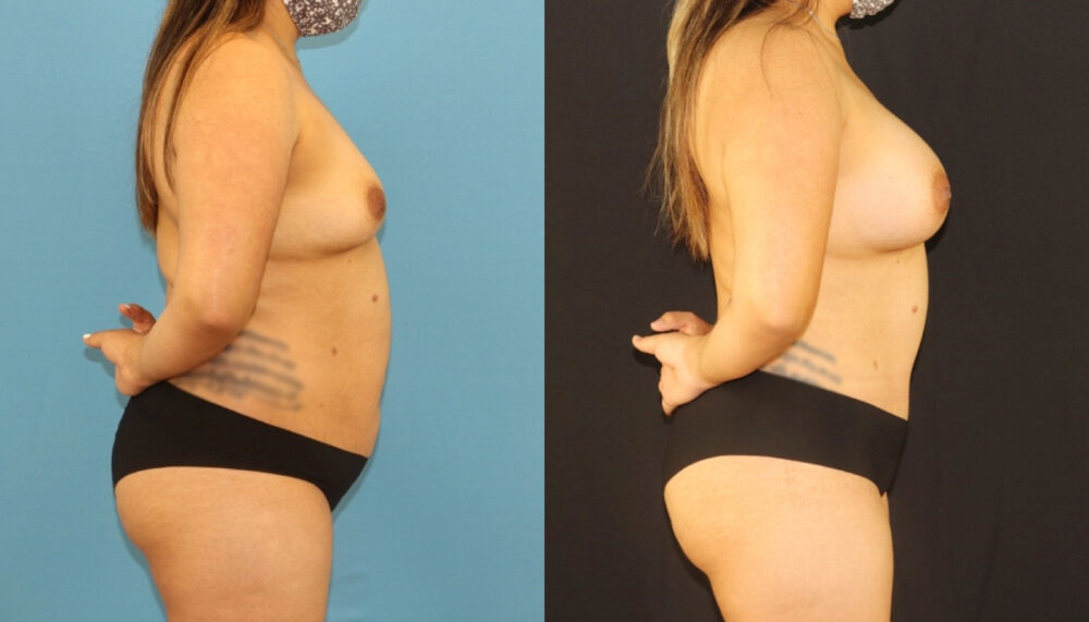 Mommy Makeover case #6513