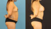 Mommy Makeover case #6513 slider thumbnail
