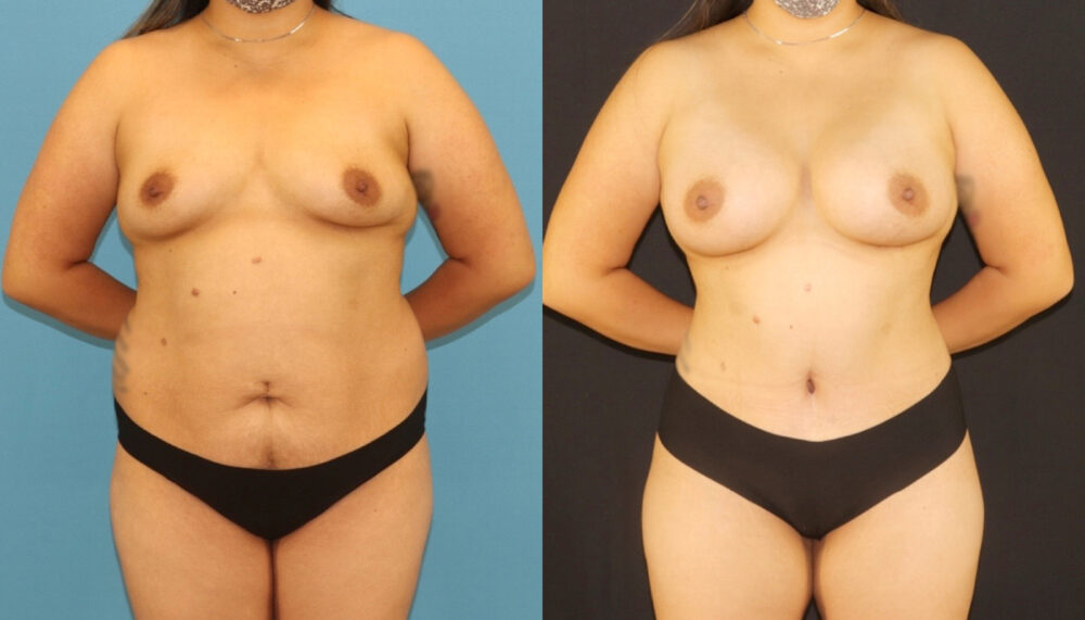 Mommy Makeover case #6513