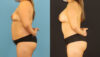 Mommy Makeover case #6513 slider thumbnail