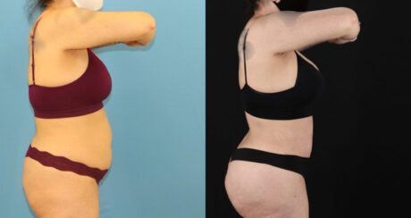Brazilian Butt Lift case #5119