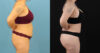 Brazilian Butt Lift case #5119 slider thumbnail