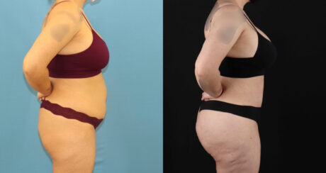 Brazilian Butt Lift case #5119
