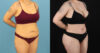 Brazilian Butt Lift case #5119 slider thumbnail