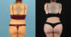 Brazilian Butt Lift case #5119 slider thumbnail