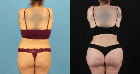 Brazilian Butt Lift case #5119
