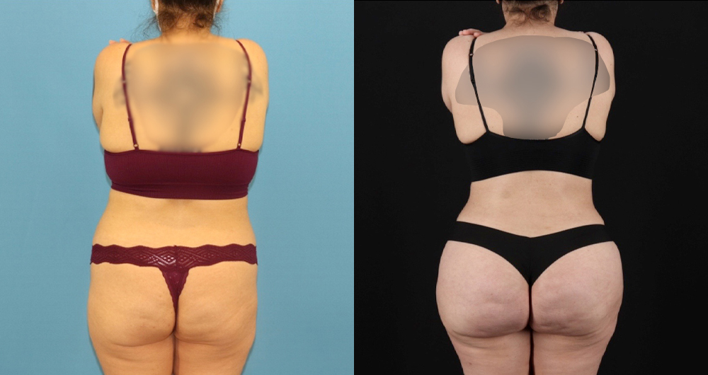 Brazilian Butt Lift case #5119