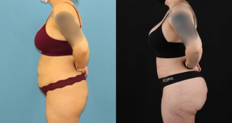 Brazilian Butt Lift case #5119