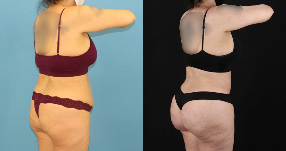 Brazilian Butt Lift case #5119