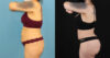 Brazilian Butt Lift case #5119 slider thumbnail
