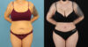 Brazilian Butt Lift case #5119 slider thumbnail