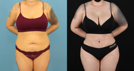 Brazilian Butt Lift case #5119