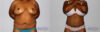 Tummy Tuck case #7090 slider thumbnail