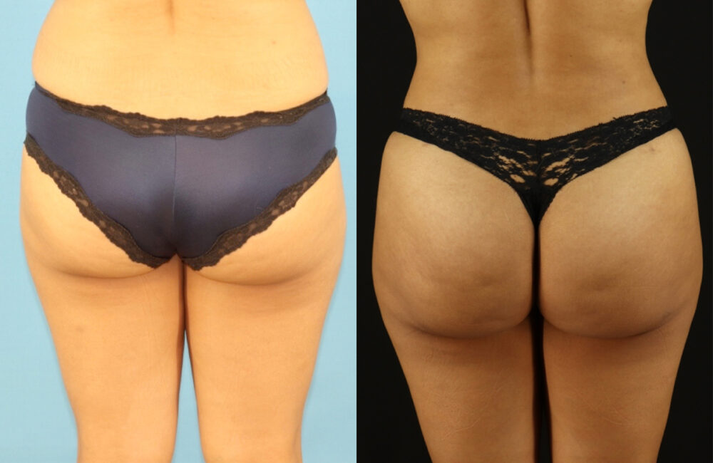 Brazilian Butt Lift case #5118