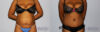 Tummy Tuck case #7079 slider thumbnail