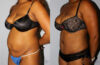 Tummy Tuck case #7079 slider thumbnail