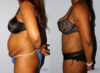 Tummy Tuck case #7079 slider thumbnail