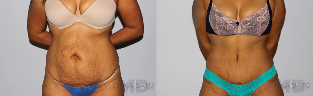 Tummy Tuck case #7092