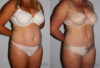 Tummy Tuck case #7091 slider thumbnail