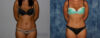 Tummy Tuck case #7225 slider thumbnail