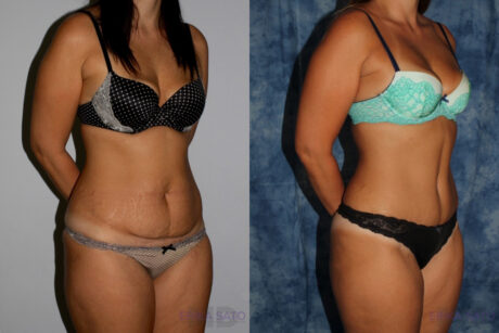 Tummy Tuck case #7225