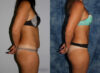 Tummy Tuck case #7225 slider thumbnail