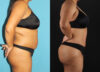 Tummy Tuck case #7349 slider thumbnail