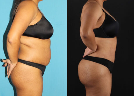 Tummy Tuck case #7349