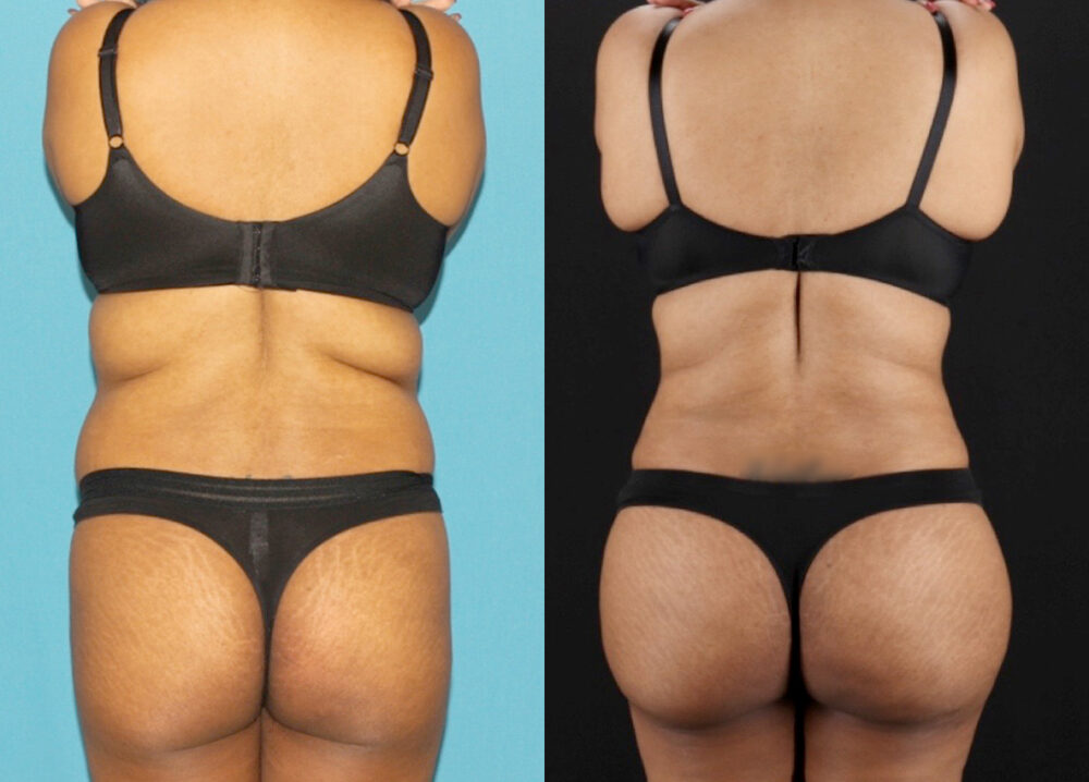 Tummy Tuck case #7349