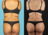 Tummy Tuck case #7349 slider thumbnail