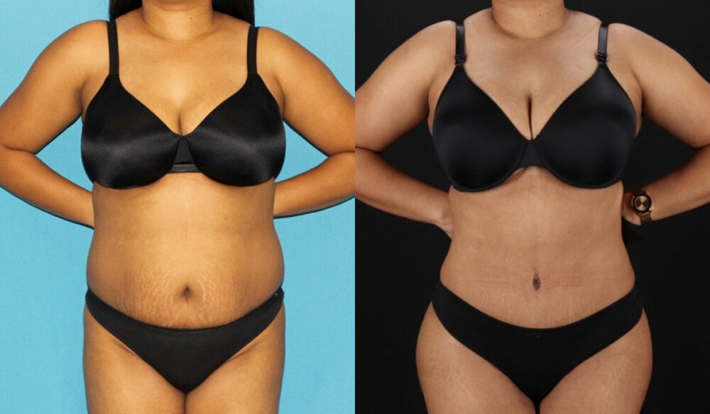 Tummy Tuck case #7349