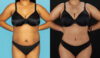 Tummy Tuck case #7349 slider thumbnail