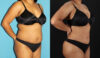 Tummy Tuck case #7349 slider thumbnail
