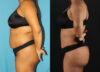 Tummy Tuck case #7349 slider thumbnail
