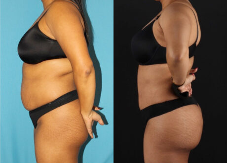 Tummy Tuck case #7349