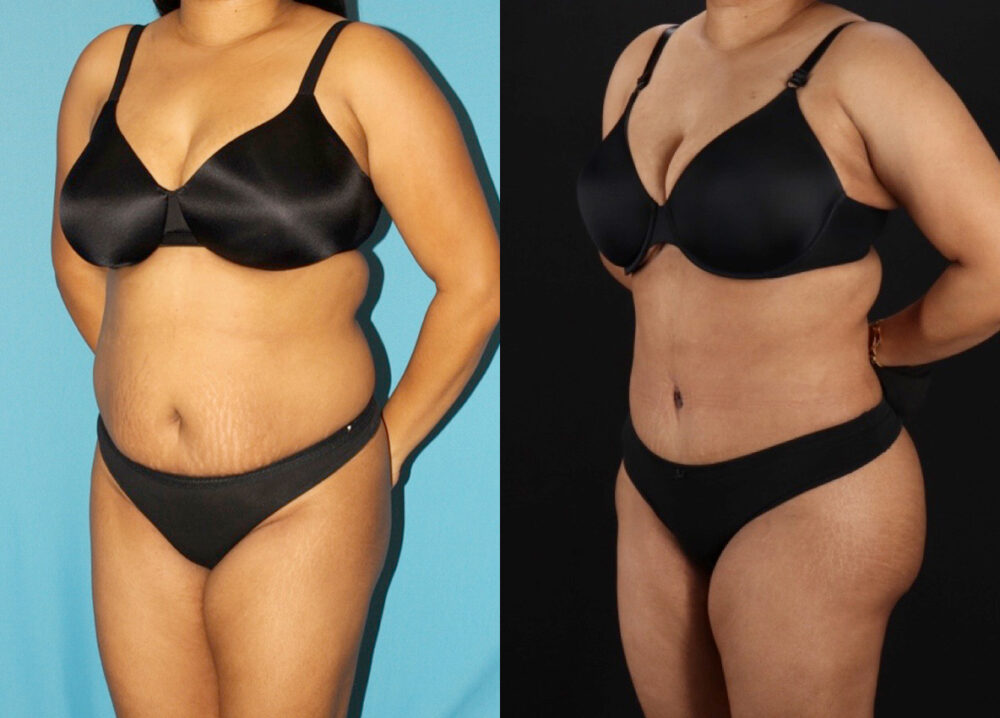 Tummy Tuck case #7349
