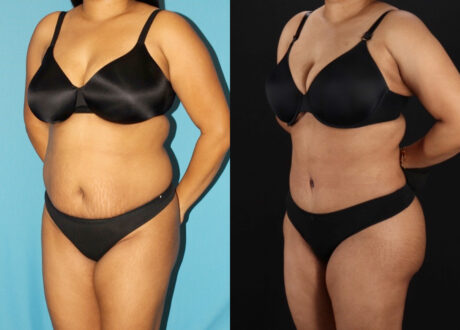Tummy Tuck case #7349