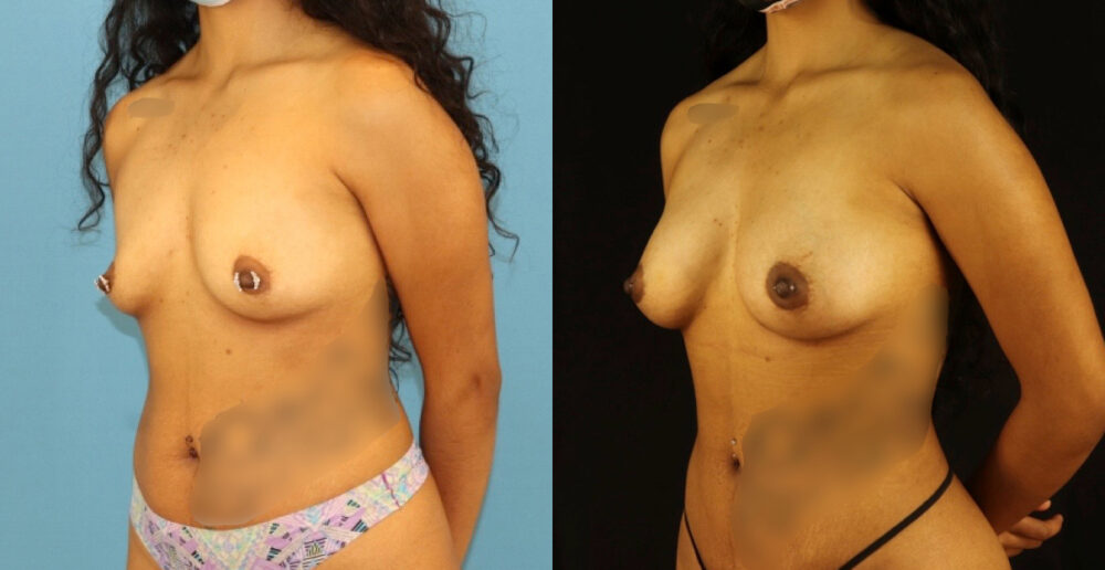 Fat Grafting to the Breast case #256207
