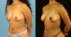 Fat Grafting to the Breast case #256207 slider thumbnail