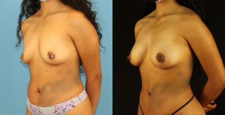 Fat Grafting to the Breast case #256207